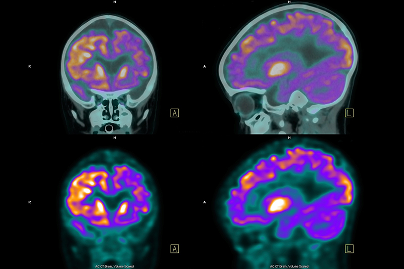 MRI imaging of a brain